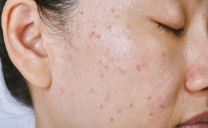 Peel da có phù hợp với da dầu mụn không?