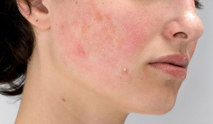 Tẩy trang khi đang bị dị ứng mỹ phẩm có cần thiết không?
