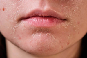Tẩy trang khi da đang bị bong tróc cần lưu ý gì?