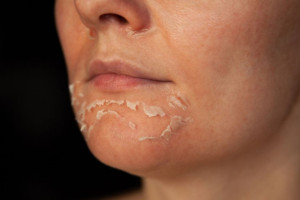Trang điểm khi da đang trong quá trình peel có ảnh hưởng gì không?