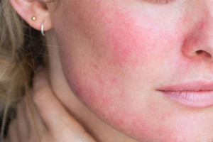 Cách nhận biết dấu hiệu peel da bị kích ứng.