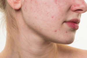 Da mụn có nên dùng tẩy trang hay chỉ cần sữa rửa mặt?