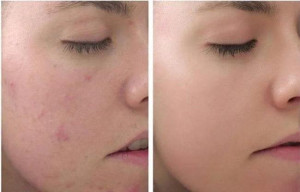 Peel da có trị thâm mụn được không?