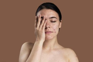 Massage mặt khi đang nổi mụn có nên hay không?