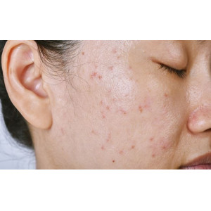 Peel da có phù hợp với da dầu mụn không?