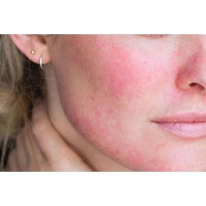 Cách nhận biết dấu hiệu peel da bị kích ứng.