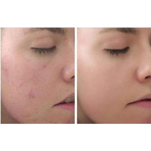 Peel da có trị thâm mụn được không?