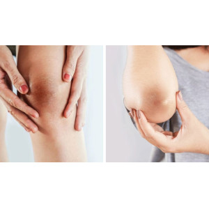 Cách làm trắng khuỷu tay và đầu gối bằng peel da tại nhà.