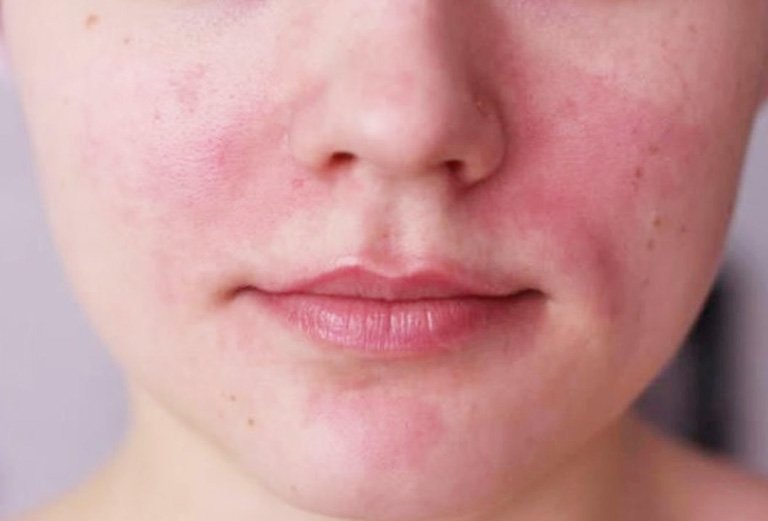Cách nhận biết da đang hồi phục sau khi peel.