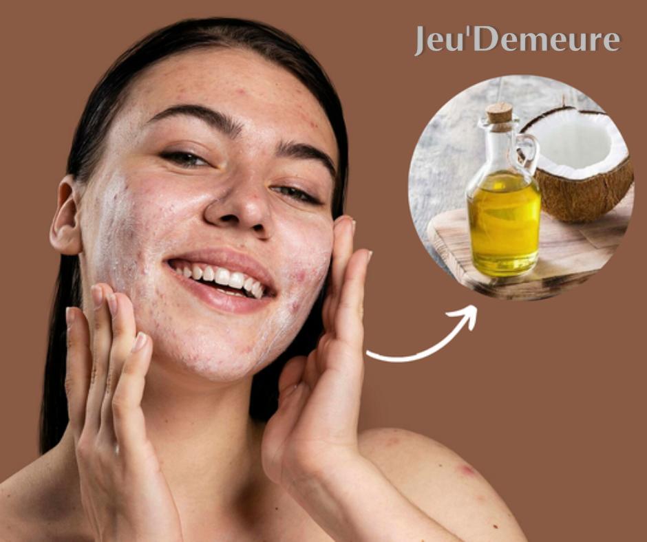 Dầu dừa có phù hợp với da dầu mụn không?