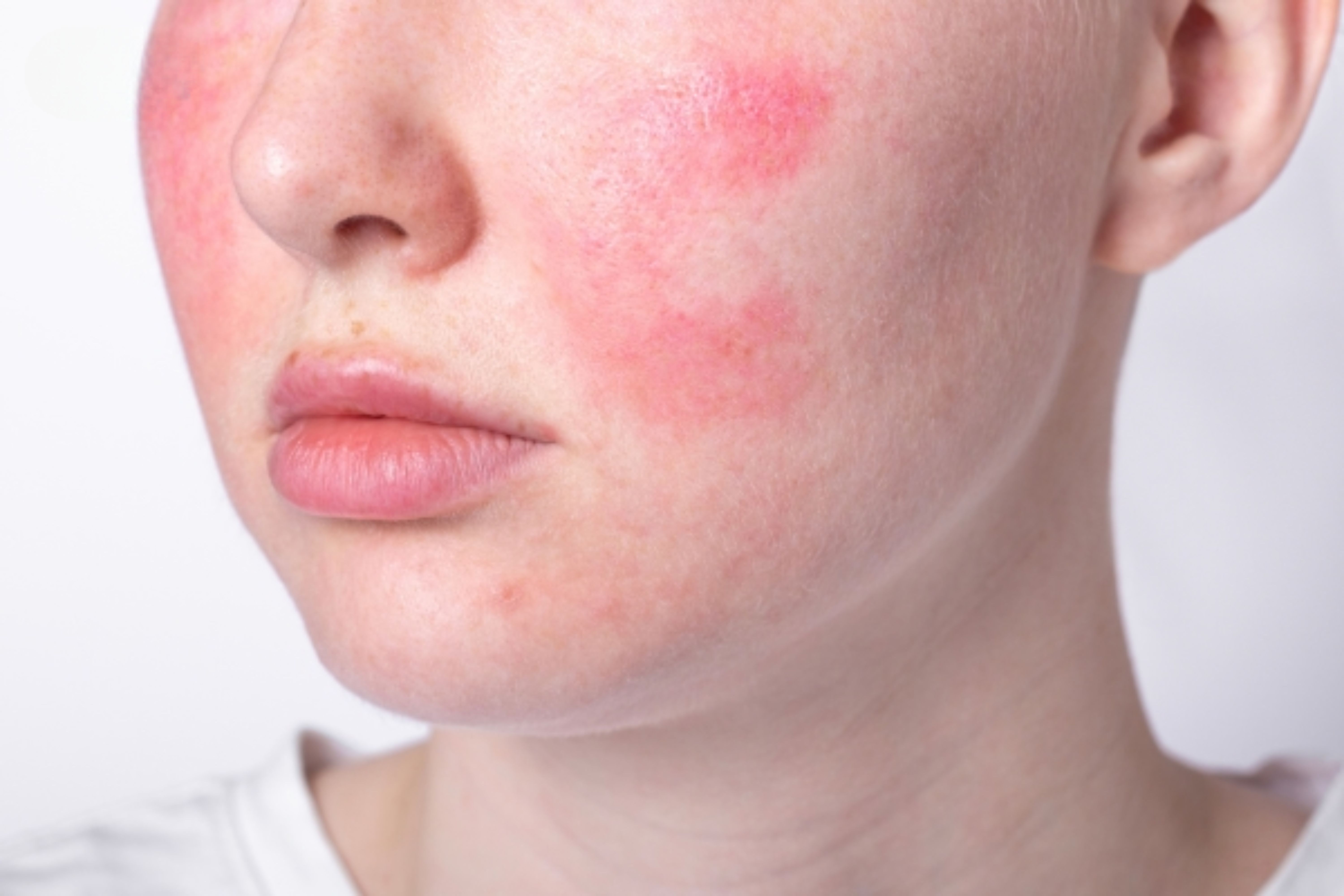 Có nên peel da khi đang skincare treatment không?