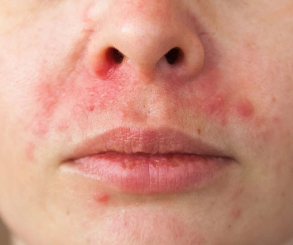 Tẩy trang nhiều nhưng da vẫn lên mụn nguyên nhân do đâu?