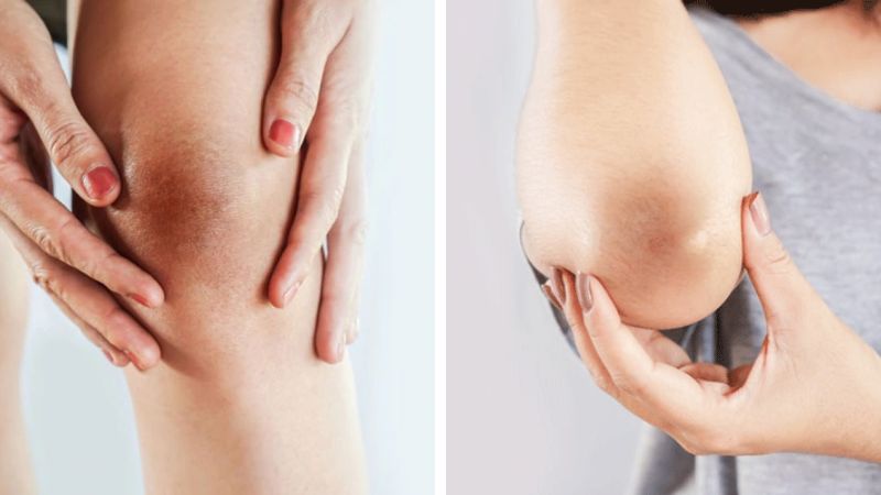 Cách làm trắng khuỷu tay và đầu gối bằng peel da tại nhà.